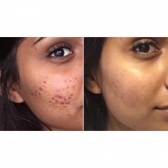 Novi tretman za akne - Acne out therapy Novi tretman za akne - Acne out therapy