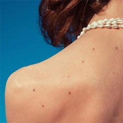 Dermatoskopski pregled Dermatoskopski pregled