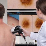 Digitalna video dermatoskopija u Poliklinici Šebetić